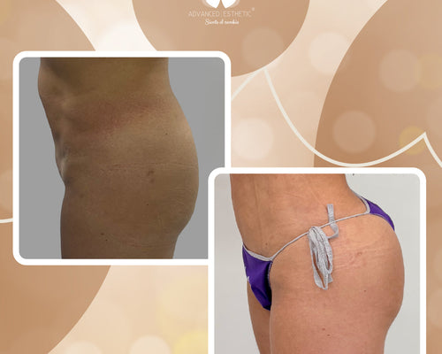 Lipotransferencia Glutea