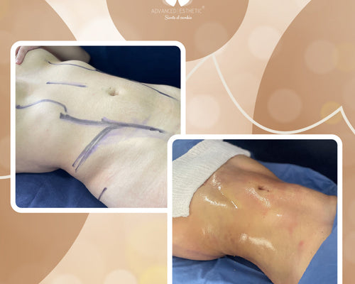 Marcación Atlética Abdominal